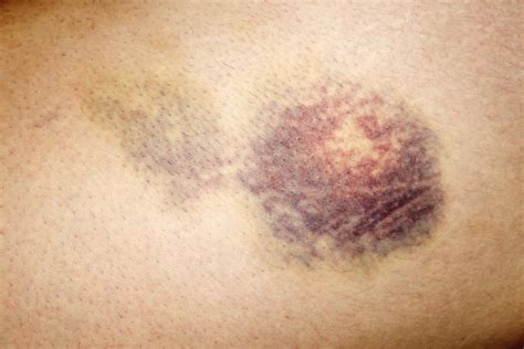 haemotoma|hematoma medical terminology.